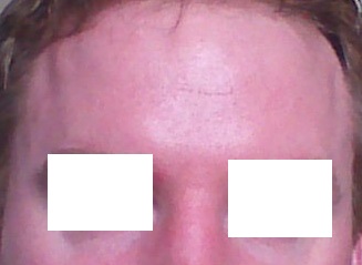 forehead_after_edited